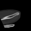 SPORK, NICO - 22.03.1976 - 02.08.2022 - CT obere Extremität - 18:02:23